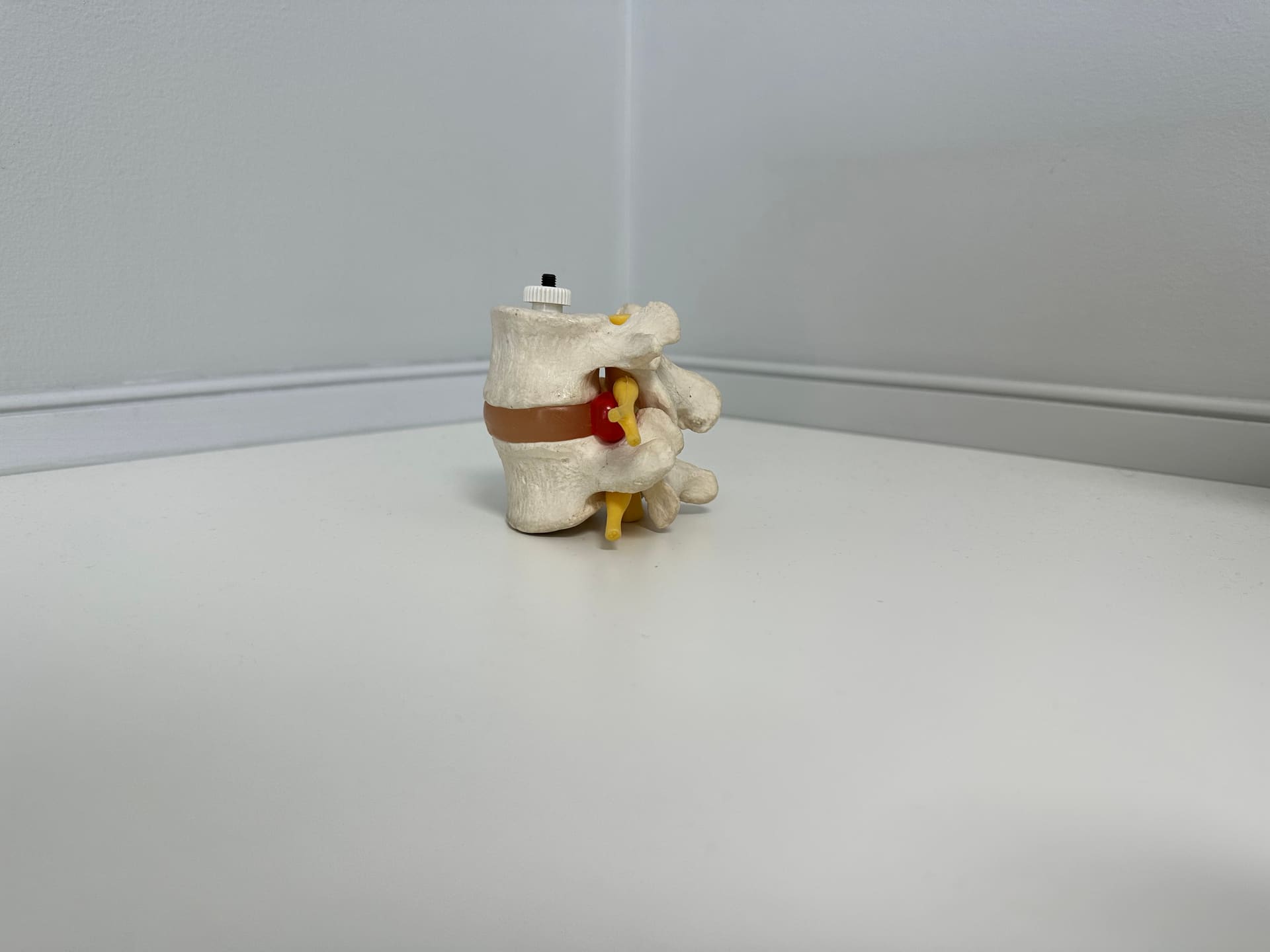 Spinal model illustrating a pinched nerve at Crest Hill Clinic